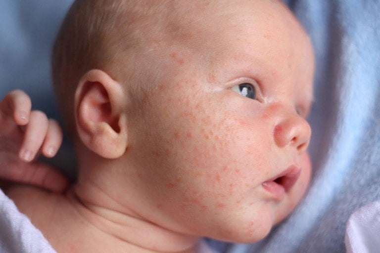 Close-up of an infant's face displaying patches of baby acne and red, irritated skin. The baby has light skin and is looking off to the side, with blue eyes and a slightly open mouth. The background consists of light blue fabric.